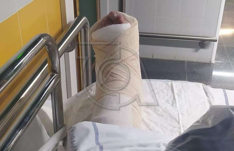 Pie de Enrique Ojeda que sufrió doble fractura de tobillo/TA.